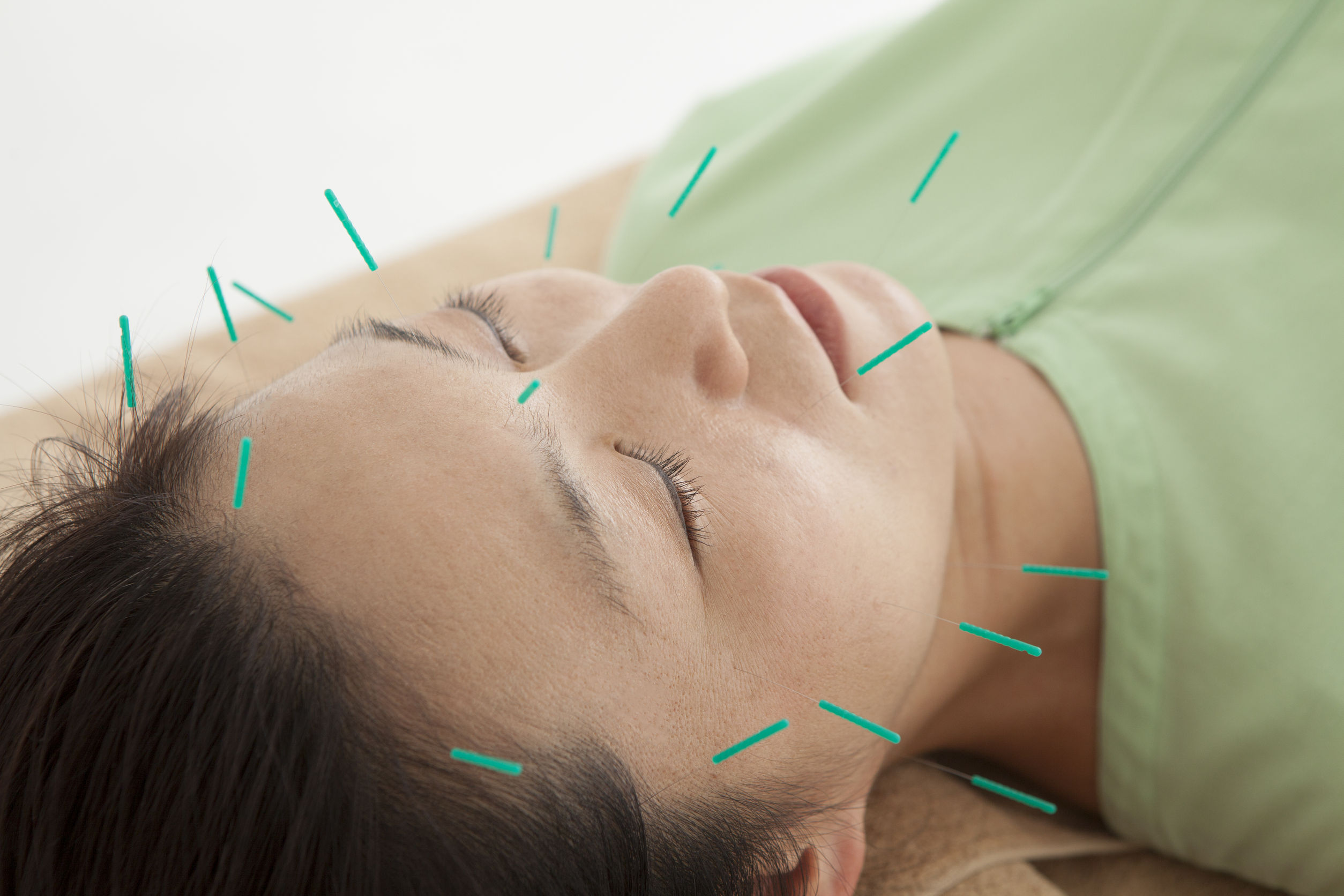 Why Medical Acupuncture Is So Beneficial Englinton Medical P C 